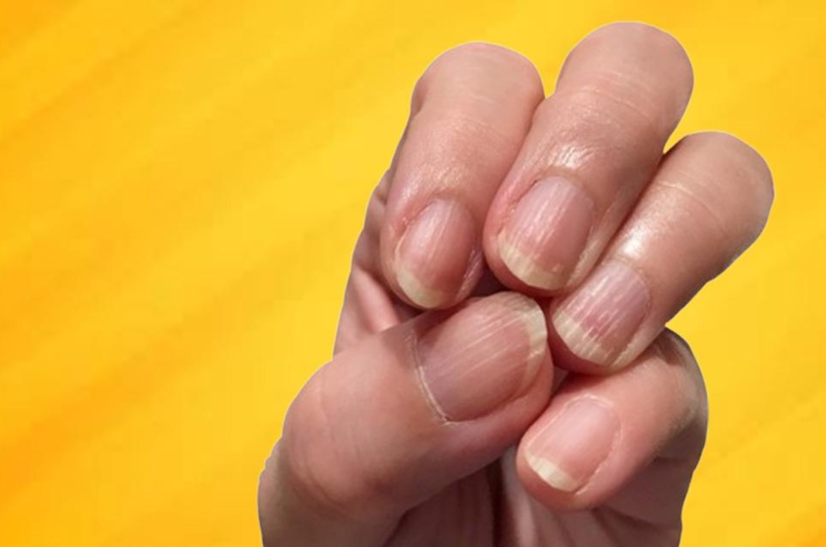 چرا خطوط عمودی یا افقی روی ناخن‌هایتان ظاهر می‌شود؟