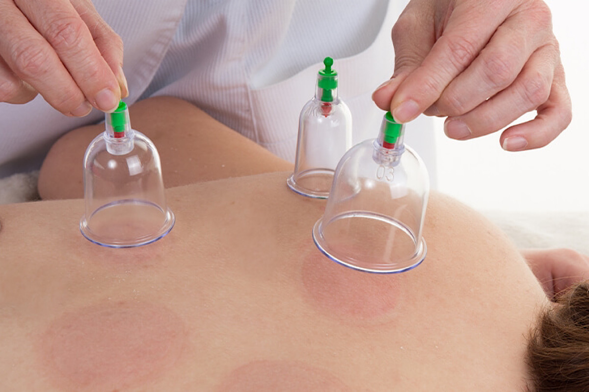 فواید «حجامت» از زبان یک پزشک آلمانی